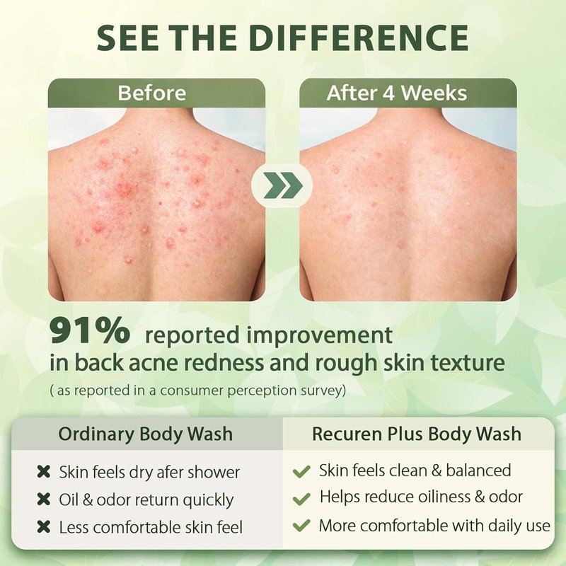 Antifungal Body Wash Soap - Antibacterial Shower Gel for Back Acne, Dermatitis & Psoriasis | 10 Fl Oz Herbal Floral