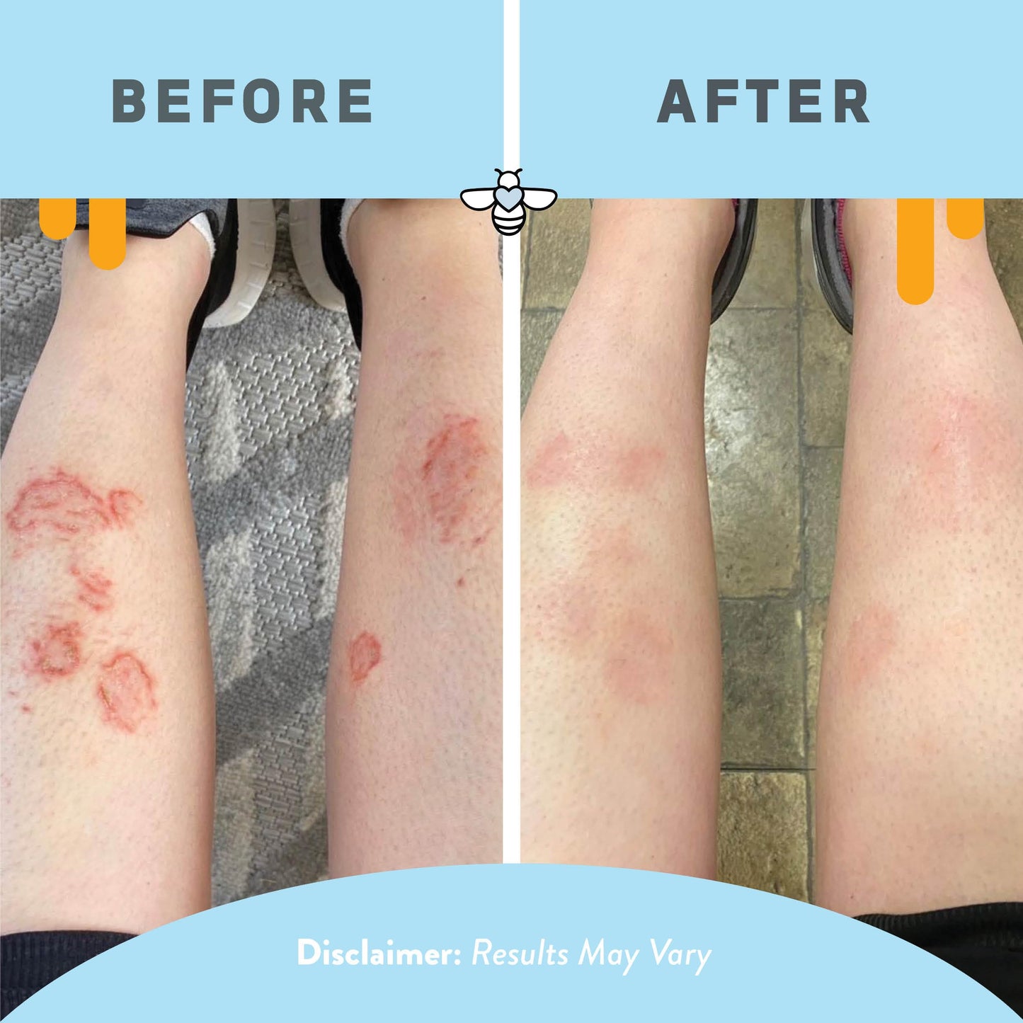 PSORIASIS HONEY Skin-Renewing Cream - Eczema & Seborrheic Dermatitis Cream - Psoriasis Treatment for Skin, Redness & Itch Relief (4oz)