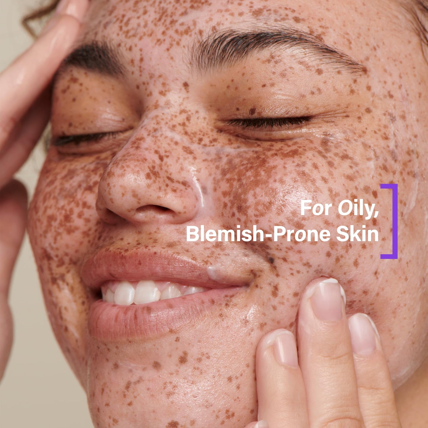 COATS Blemish Defense Clay Cleanser for Oily, Blemish-Prone Skin – With Kaolin, Glycolic & Salicylic Acid – Helps Prevent Breakouts – 5 oz