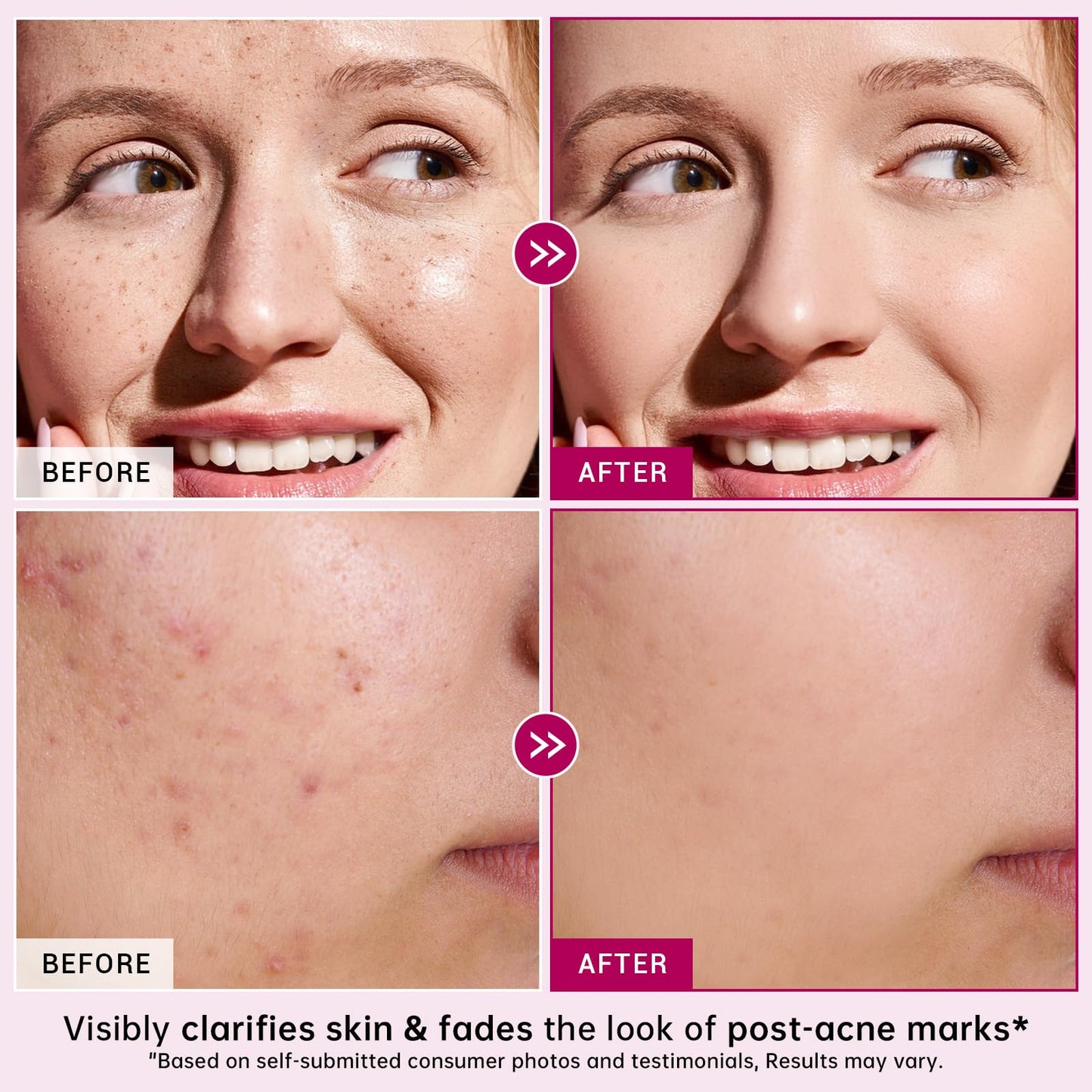 14% Azelaic Acid Acne Cream with Niacinamide & Centella,Azelaic Acid Facial Serum–Smooth & Even Skin Tone,Reduce the Appearance of Blemishes,Dark Spots&Uneven Skin,Gentle Hydrating Formula,1.4oz,2PCS