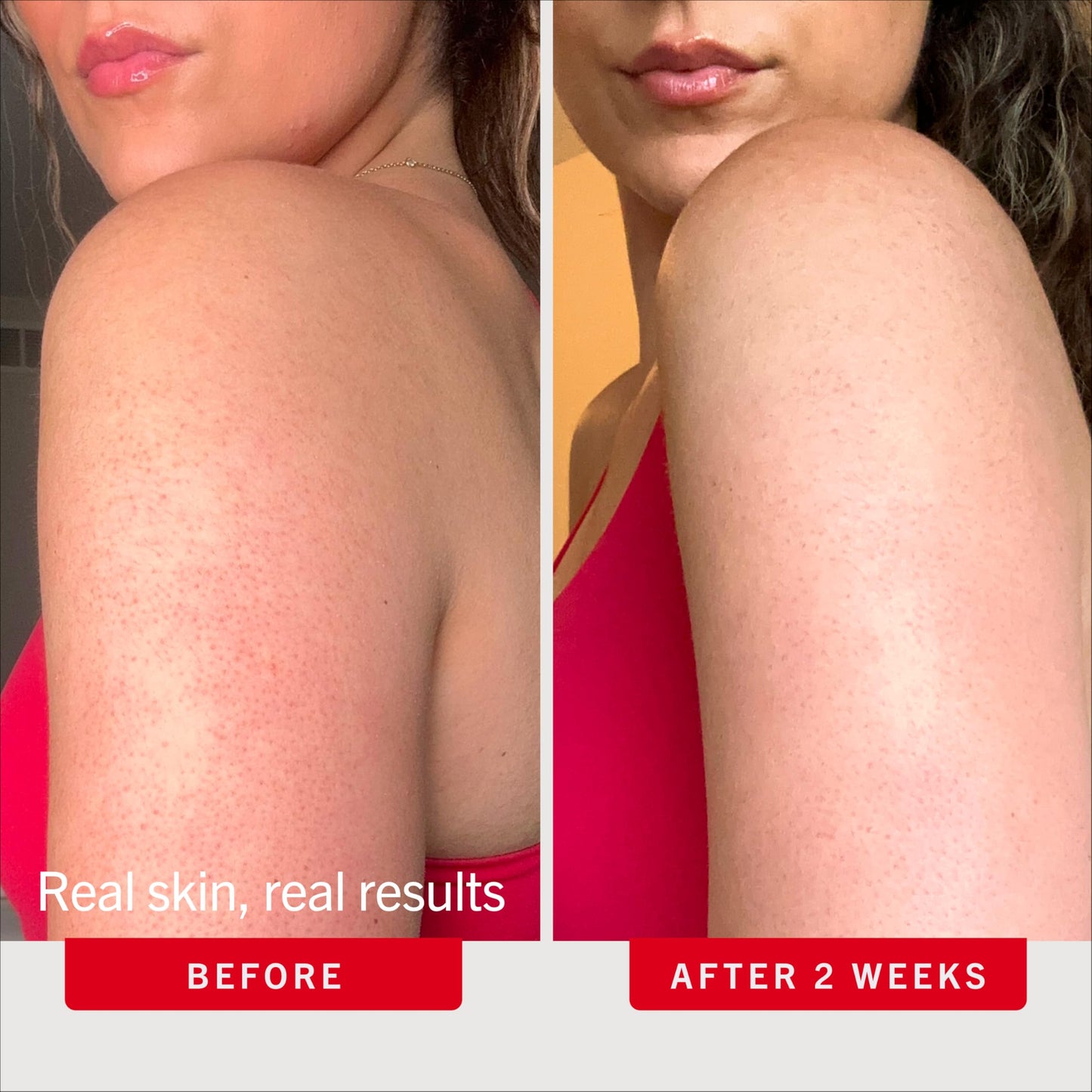 First Aid Beauty KP Bump Eraser Body Scrub with 10% AHA - Dermatologist-Tested Keratosis Pilaris Exfoliator - Support for Rough Bumps & Uneven Skin Texture - Sensitive Skin - 8 oz, Fresh Peach