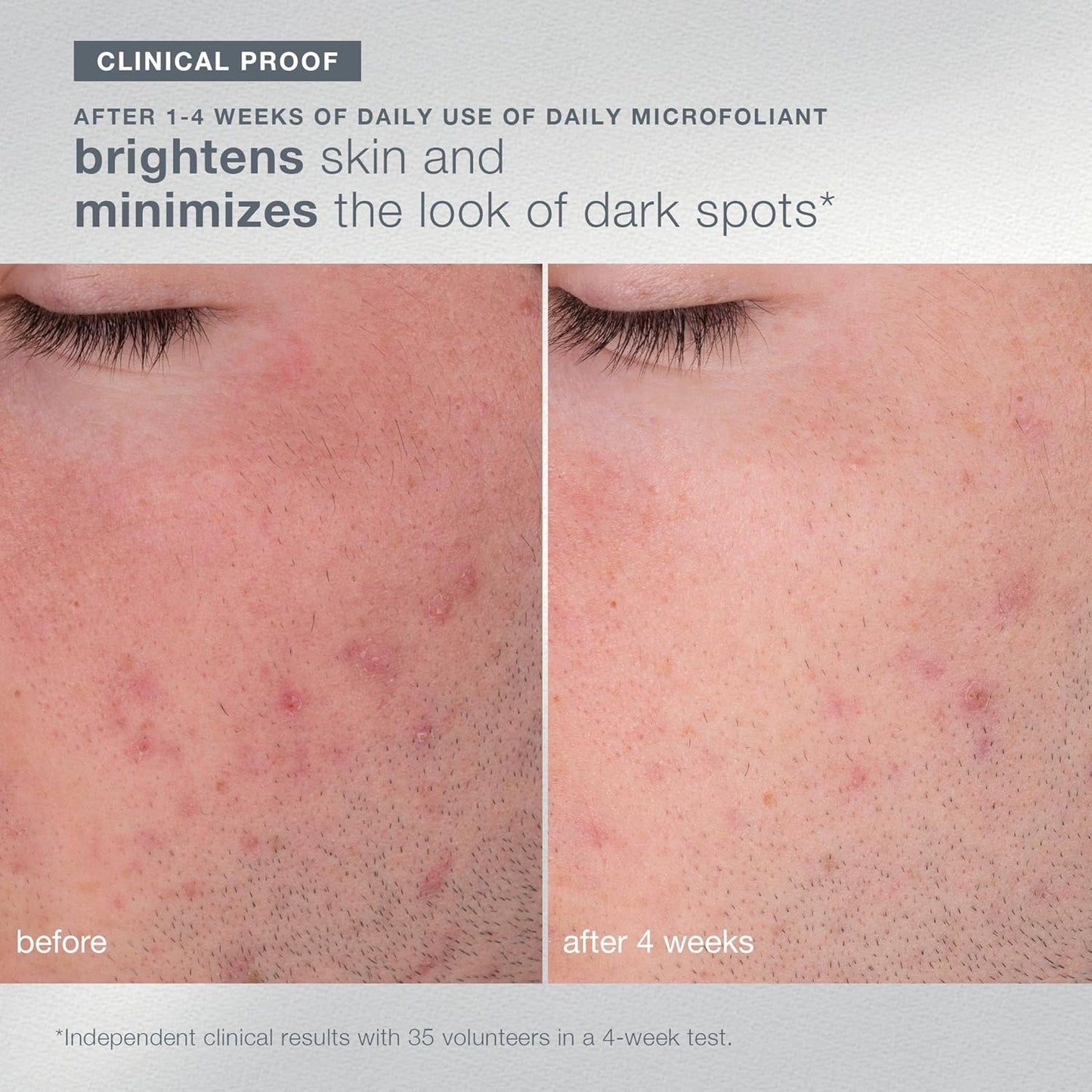 Dermalogica Travel-Sized Skin Care Set | Face Exfoliants, Serum & SPF Moisturizer