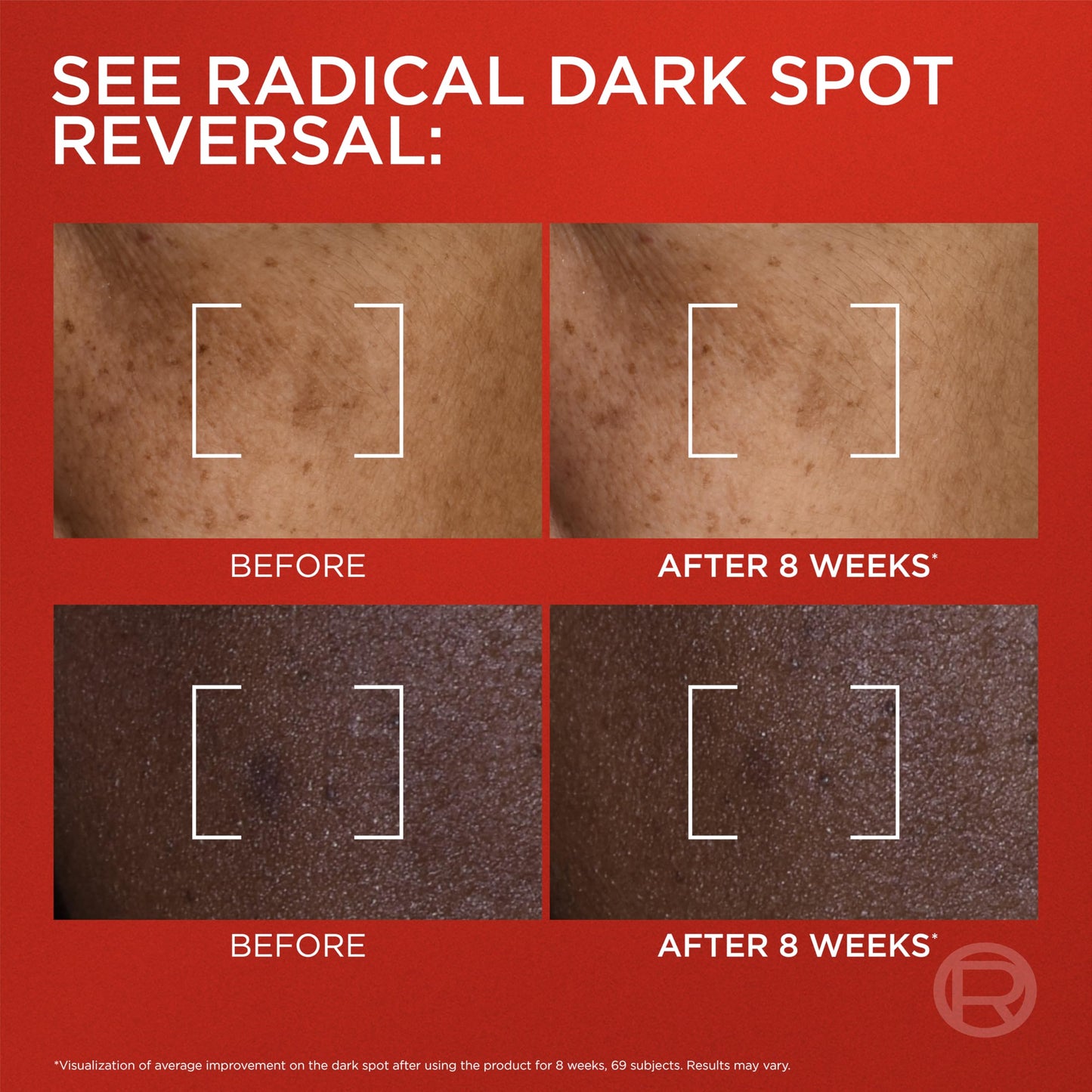 L'Oreal Paris Revitalift Triple Power Dark Spot Corrector Creamy-Serum, Hyperpigmentation Treatment With Melasyl, Vitamin C & Niacinamide, Treats Sun Spots, Dark Spots, Aging & Uneven Tone, 1.7 fl oz
