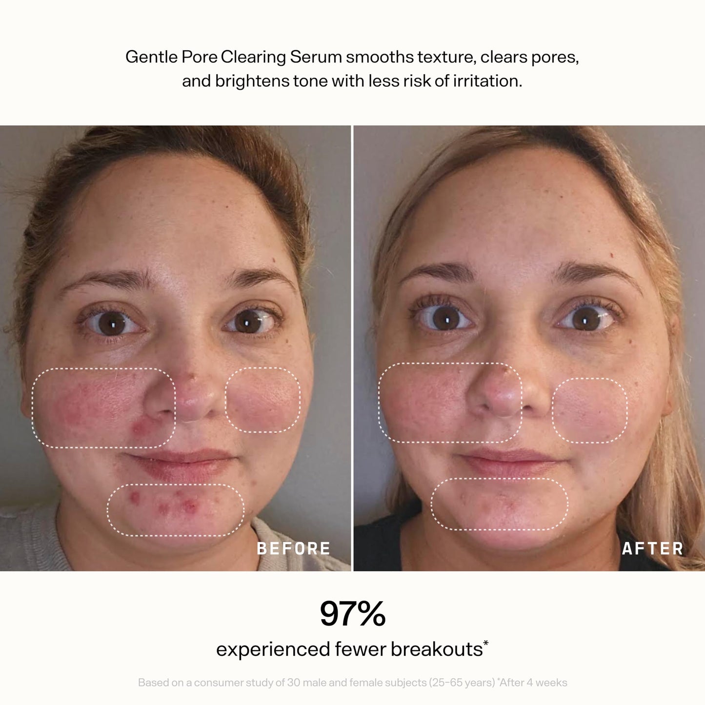 VERSED Skin Refine Gentle Pore Clearing Serum | Exfoliating Facial Serum with Salicylic Acid and Mandelic Acid for Clear Skin | Safe for Sensitive Skin, Vegan, 30 ml / 1 fl oz