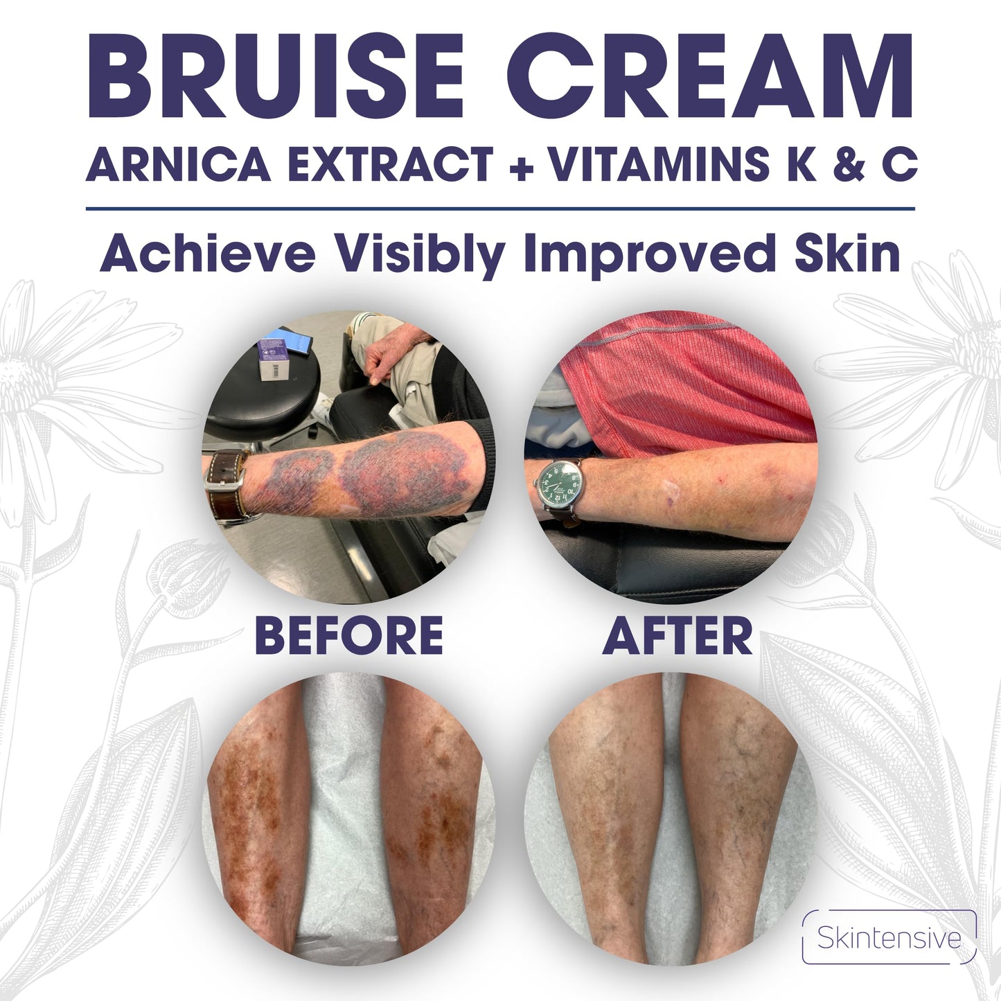 SKINTENSIVE Bruise Cream + Crepe Cream Bundle, Non-Greasy Moisturizer for Bruise-Prone, Thin, or Crepey Skin, With Niacinamide, Hyaluronic Acid, and Botanicals, Dermatologist Developed