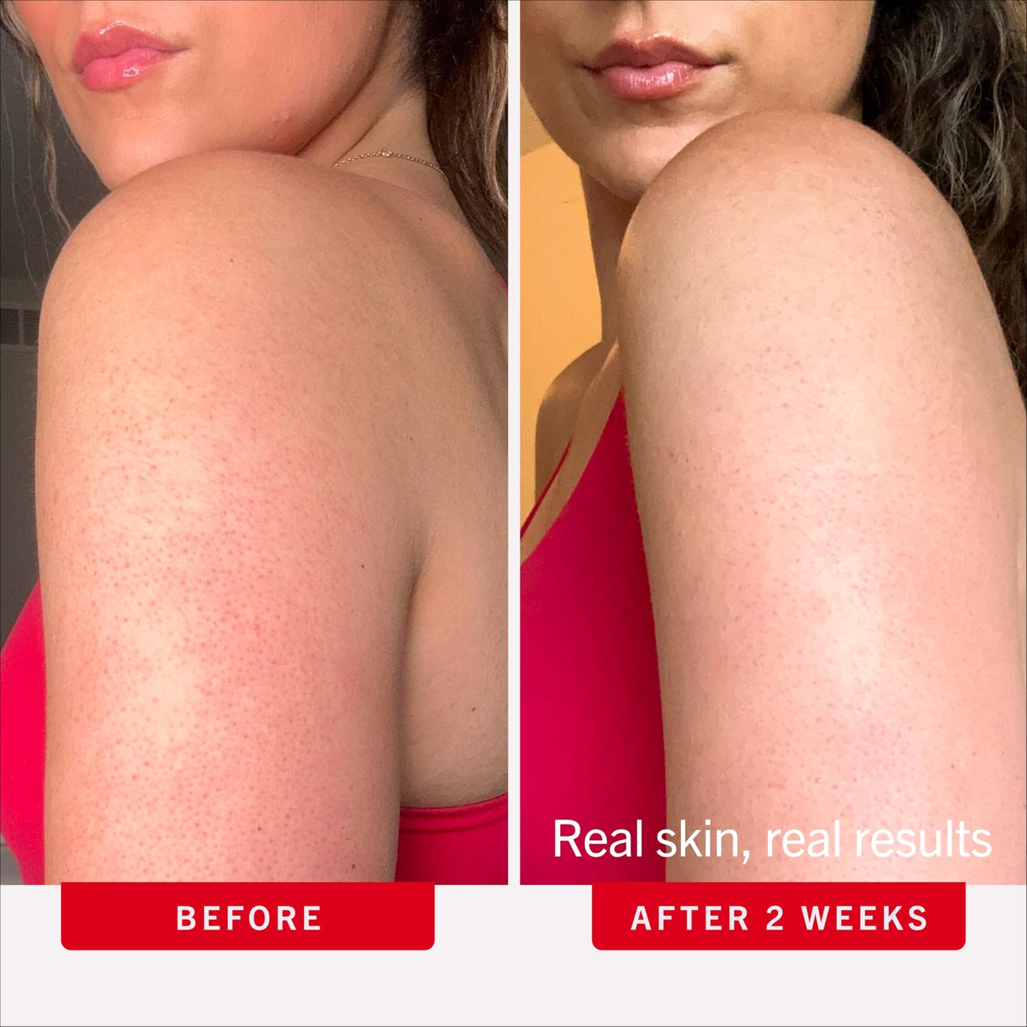First Aid Beauty KP Bump Eraser Body Scrub with 10% AHA - Dermatologist-Tested Keratosis Pilaris Exfoliator - Support for Rough Bumps & Uneven Skin Texture - Sensitive Skin - 8 oz, Fresh Strawberry