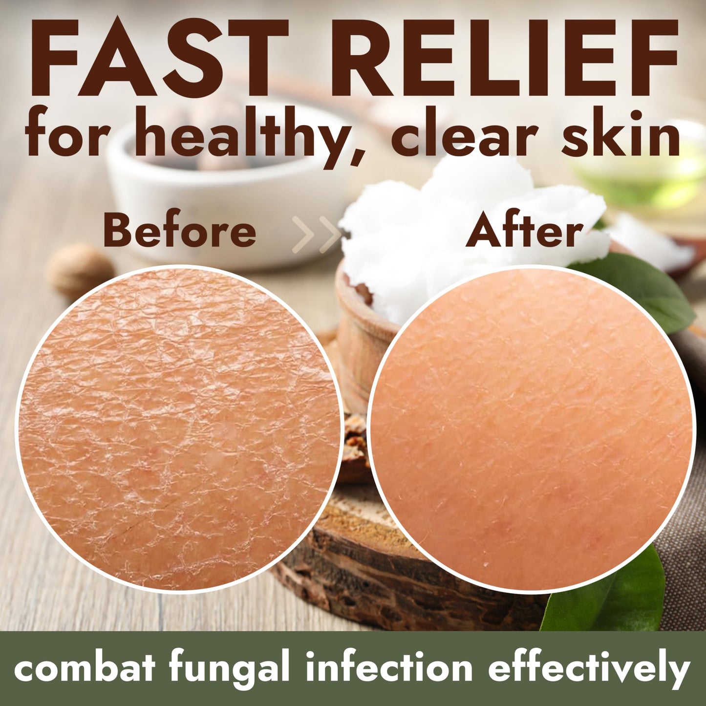 Antifungal Soap Infused with Shea Butter & Rose Oil | Medicated Jock Itch Treatment Helps Fight Ringworm & Athlete’s Foot | Tolnaftate 1% Antifungal Soap for Deep Cleansing | 2 Bars with Scrubber