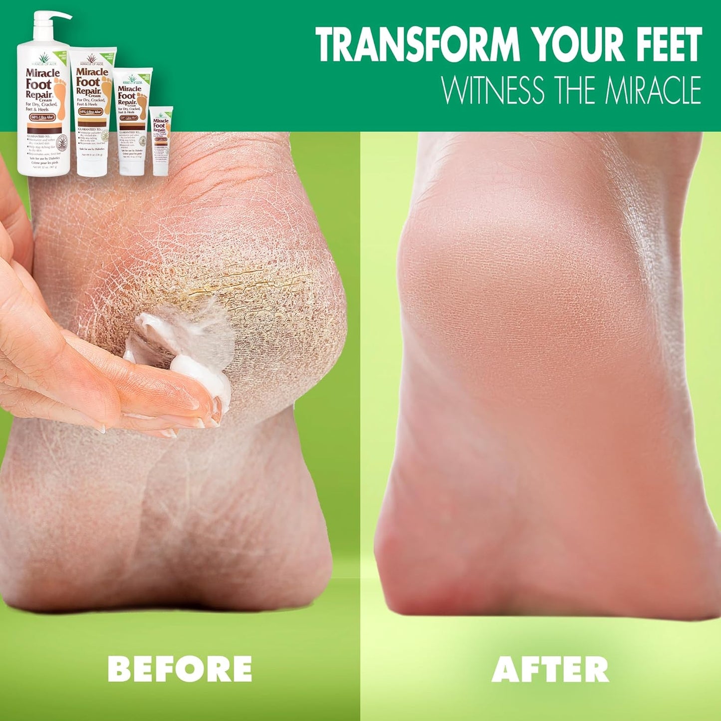 Miracle Foot Repair Cream (1 oz / 12 Pack) Repairs Dry Cracked Heels and Feet, 60% Pure Ultra Aloe Moisturizes, Softens, and Repairs
