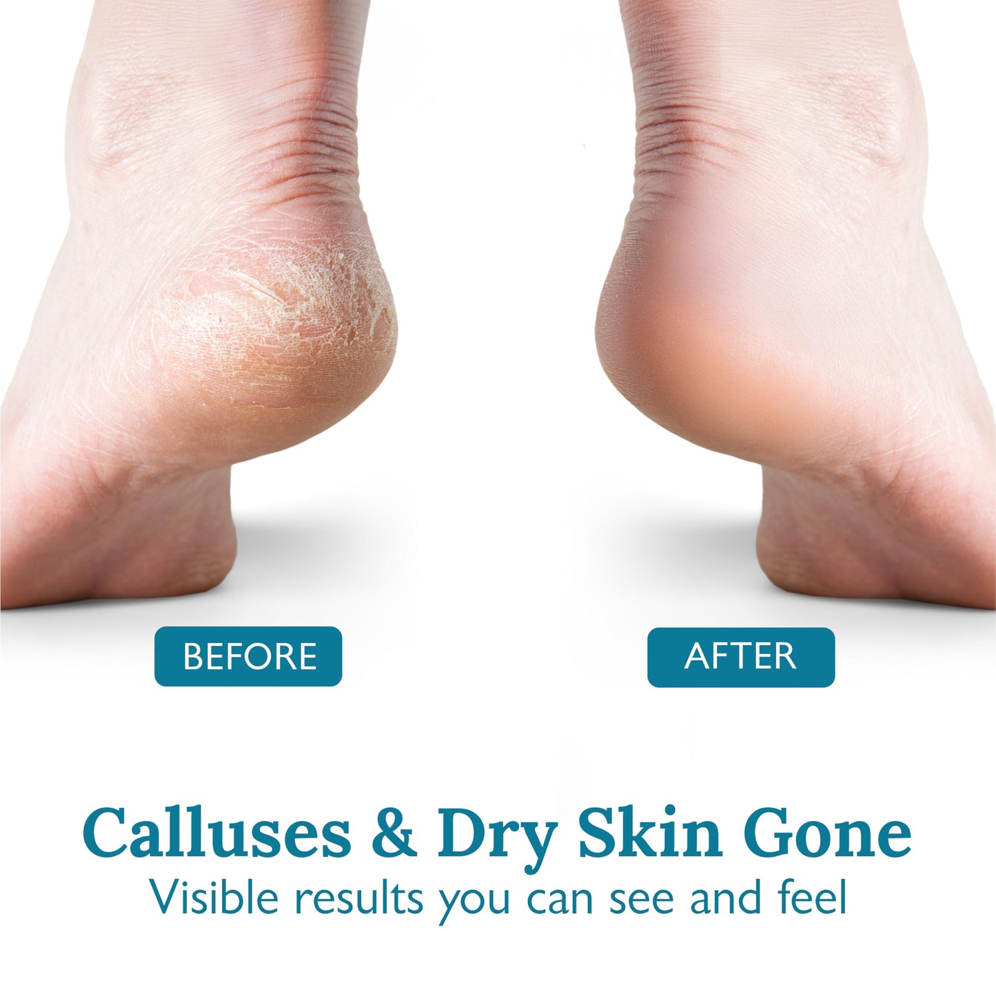 Foot Callus Remover Kit - 40% Urea Cream & Handmade Terra-Cotta Pumice Stone for Feet - Callus Remover for Feet with Shea Butter & Aloe Vera - Cracked Heel Treatment & Moisturizer