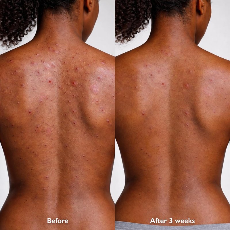 Orbe It! 2-Step Acne Treatment - Salicylic Acid Spray & Cream for Face & Body | Unclogs Pores, Reduces Pimples & Back Acne