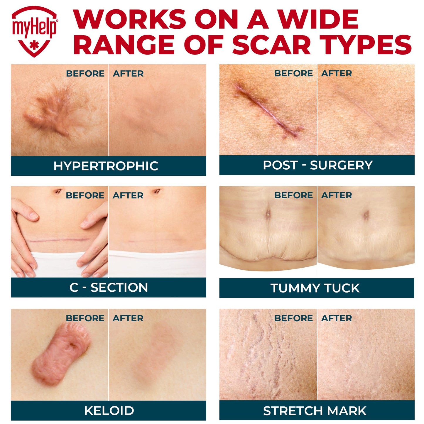 Medical Grade Silicone Scar Tape - 1.6”x60” - Visible Difference on Surgical & Keloid Scars - Reusable Silicone Scar Sheets - Easy to Use Silicone Tape for Scars