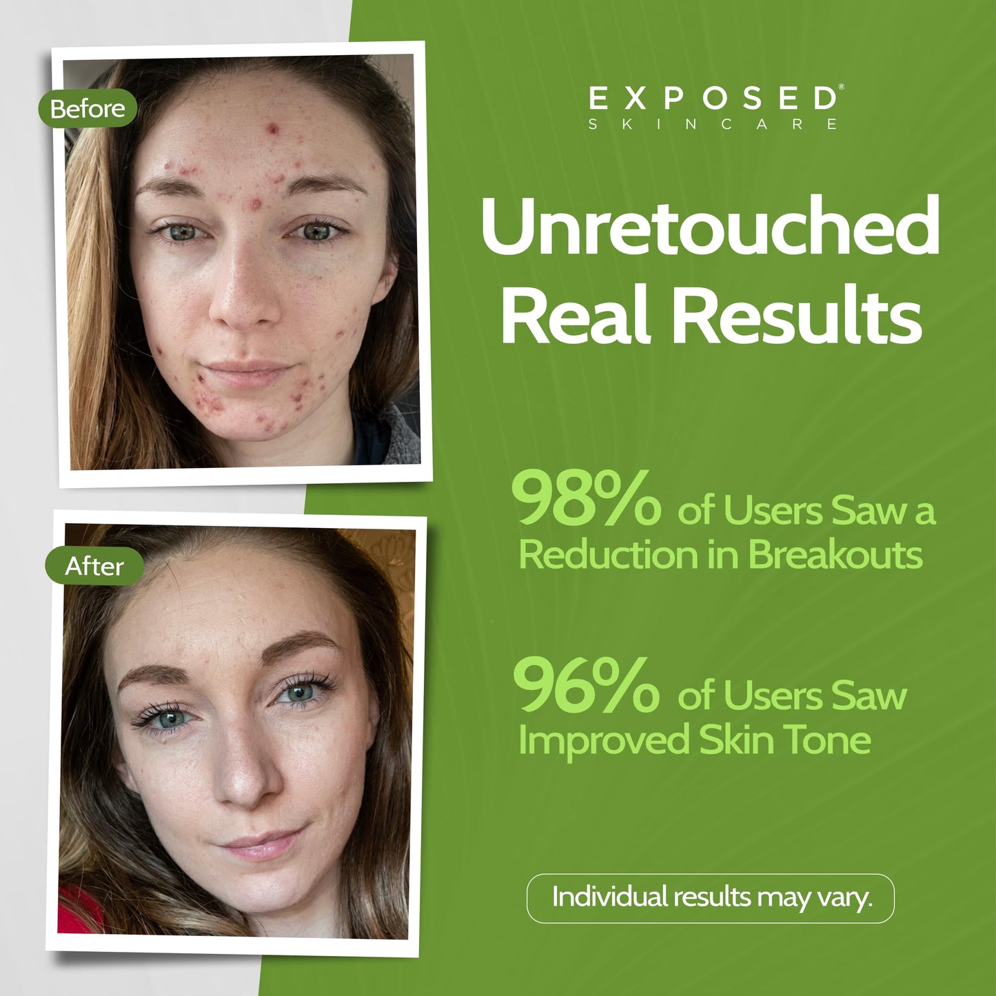 Exposed Skin Care, Acne Treatment Kit with 2.5% Salicylic Acid and 3.5% Benzoyl Peroxide to Clear Up Teen, Adult, Hormonal and Cystic Acne – Natural, Non-toxic and Cruelty Free
