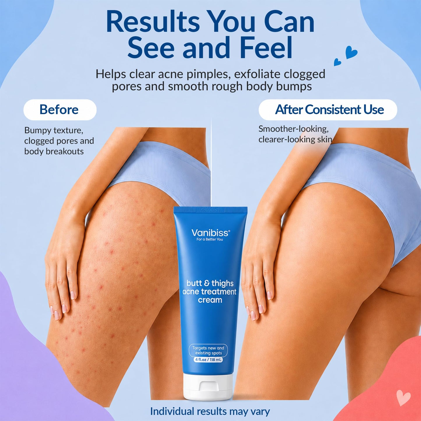 Vanibiss Butt & Thighs Acne Treatment Cream, 2% Salicylic Acid, 4 fl.oz