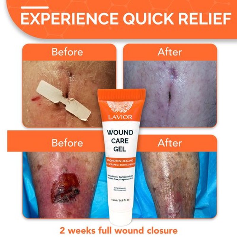 Hydrogel Wound Care Scar Gel - Fast Healing Ointment, Support Skin Repair - Clinically Tested, Hypoallergenic, Paraben & Steroid-Free. Podiatrist's Choice. Made in USA, by LAVIOR (2 Pack)
