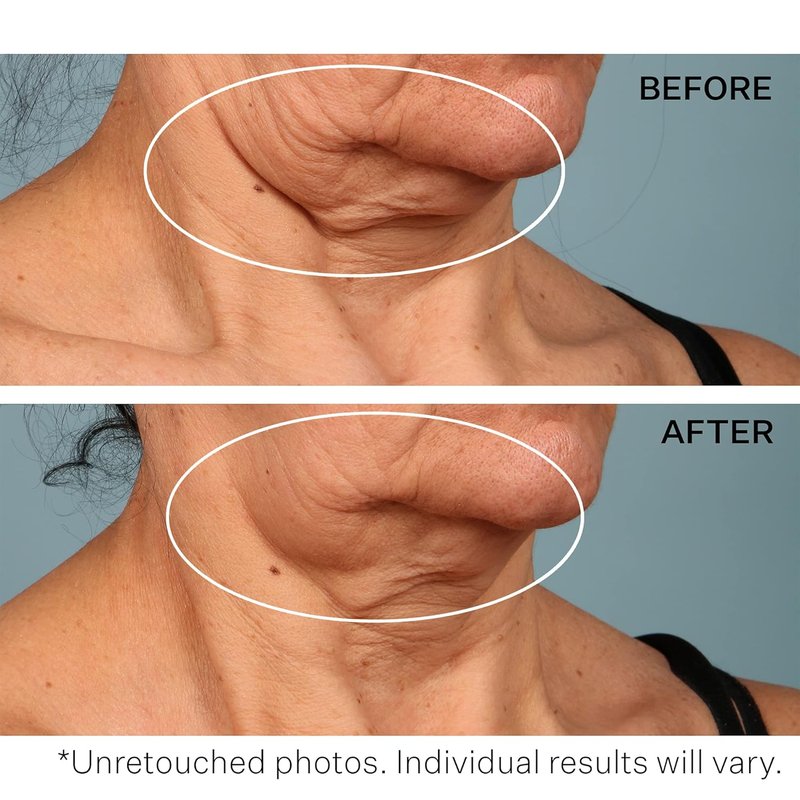 StriVectin Neck Cream - Tighten & Lift with Alpha-3 Peptides™ | Smooth Wrinkles & Fine Lines, 1.7 oz
