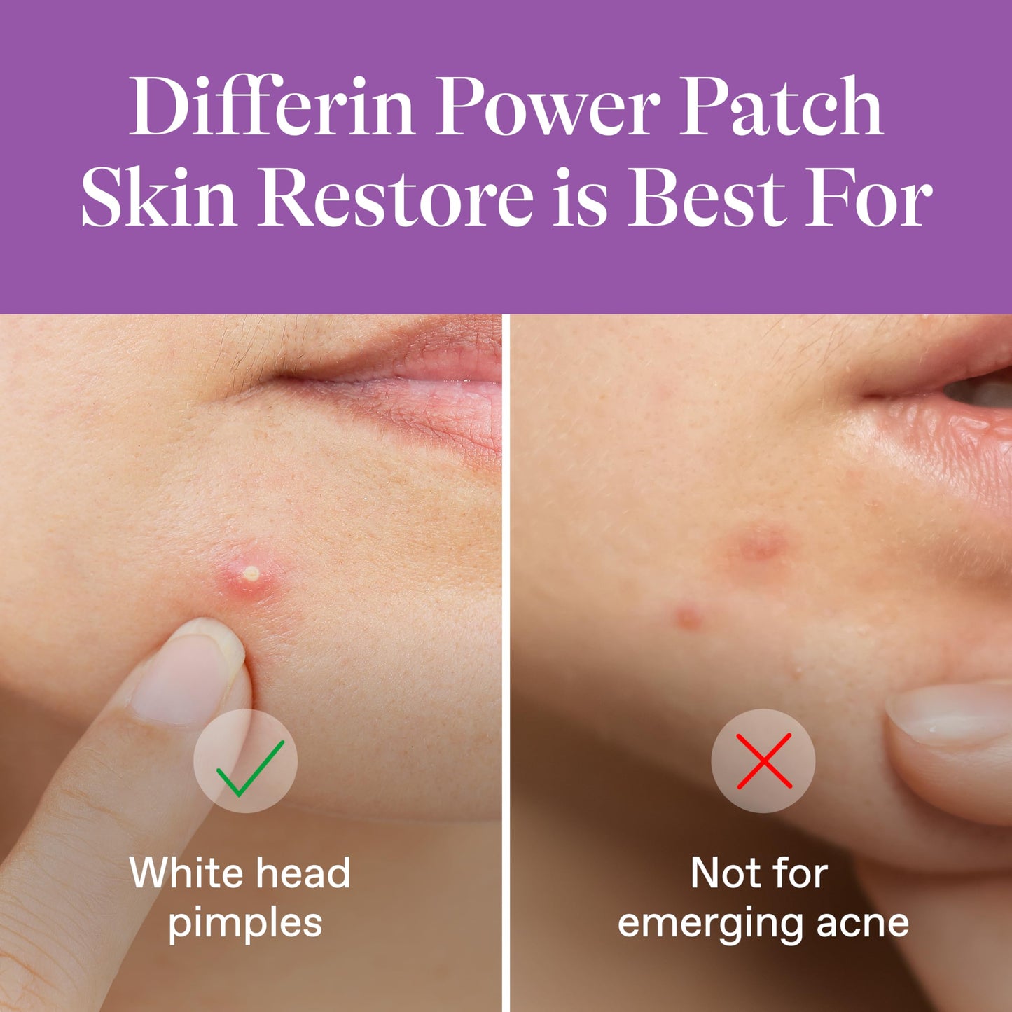 Differin Power Pimple Patches, Hydrocolloid Acne Treatment, 23 ct