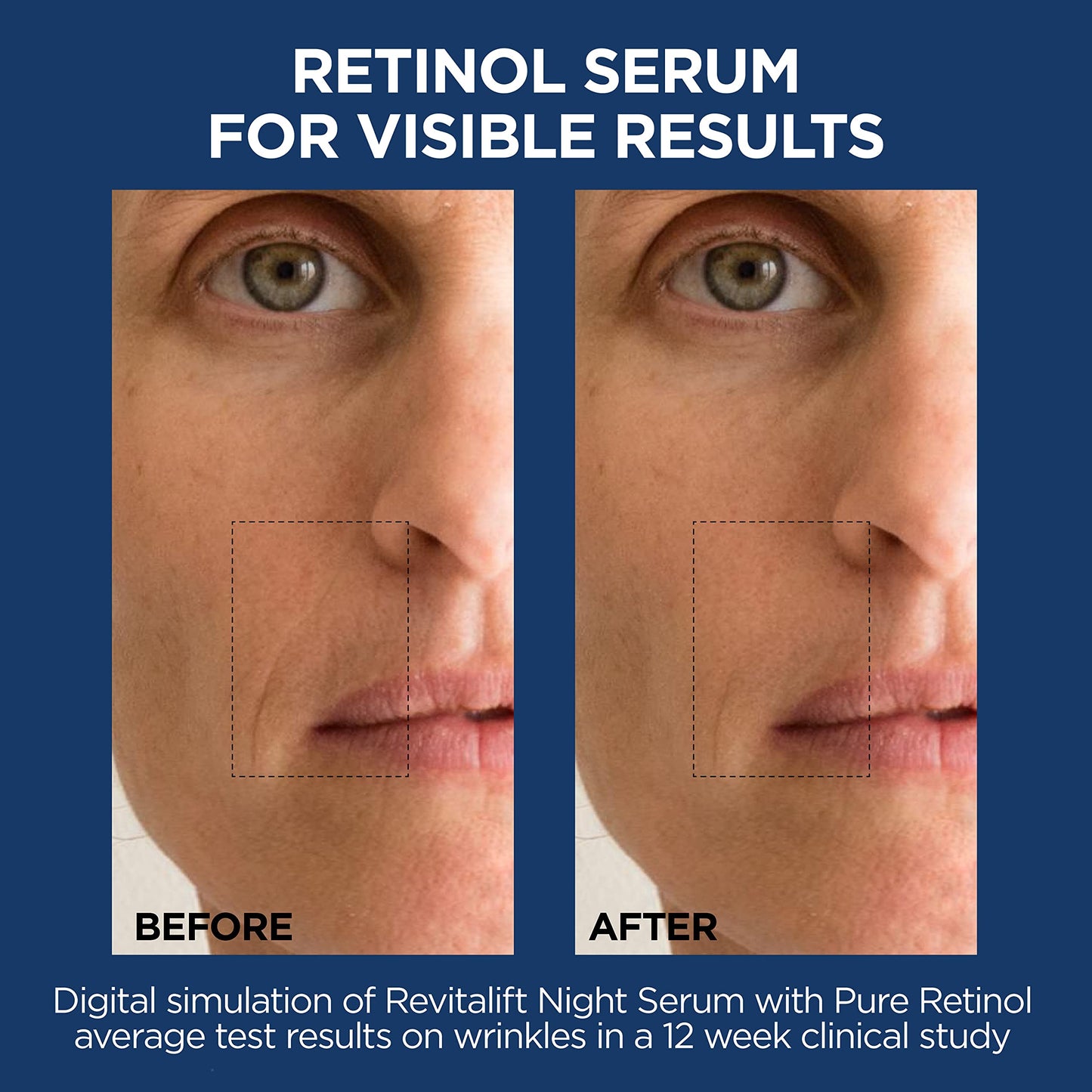 L'Oreal Paris Revitalift 1.5% Pure Hyaluronic Acid Face Serum + 0.3% Pure Retinol Night Serum, 1 kit