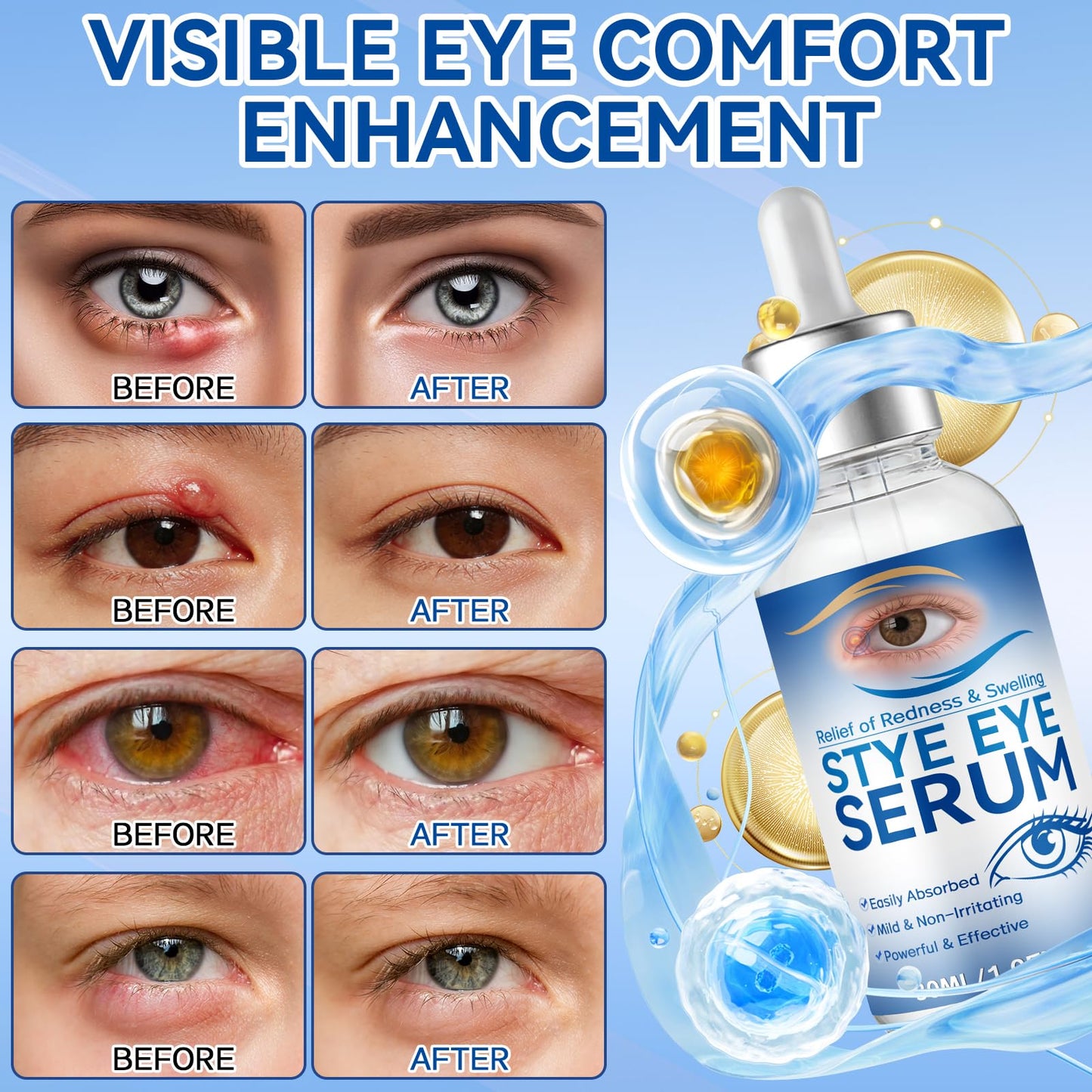 Stye Eye Treatment, 30ml Natural Eye Serum, Eye Stye Relief Serum for Eye Styes, Blepharitis, Chalazions and Dry Eyes Treatment, Daily Area Cleansing, Relieves Dryness and Restores Healthier Skin