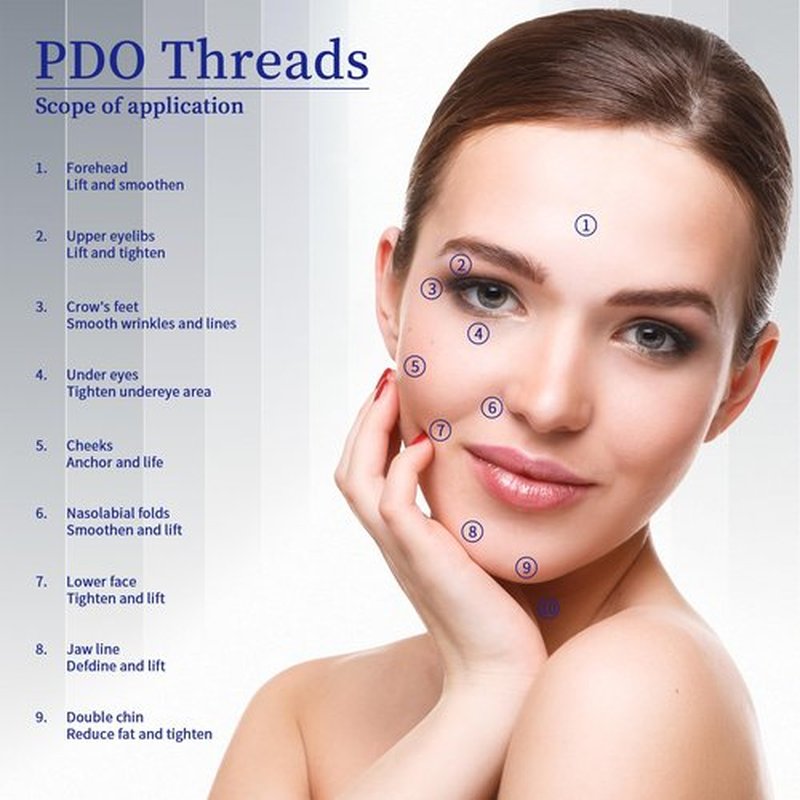 SOZOOM PDO Screw Threads, PDO Thread Lift Korea Pdo Threads Whole Body Lifting (100PCS-27G-50mm)