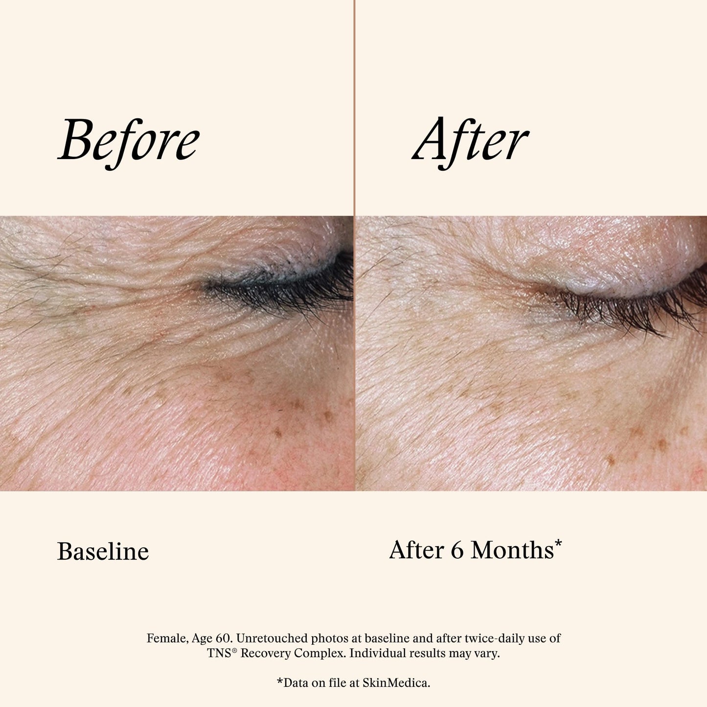 SkinMedica TNS Recovery Complex Facial Treatment - Advanced Growth Factor & Exosome Formula for Skin Rejuvenation - Helps to Improve the Appearance of Fine Lines, Wrinkles, and Uneven Skin Tone (1 Oz)