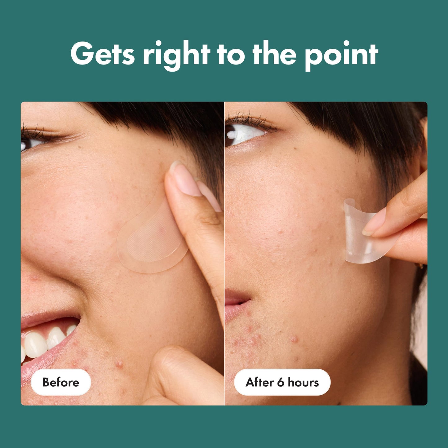 Mighty Patch Hero Cosmetics Micropoint XL Acne Pimple Patches, 6 Ct