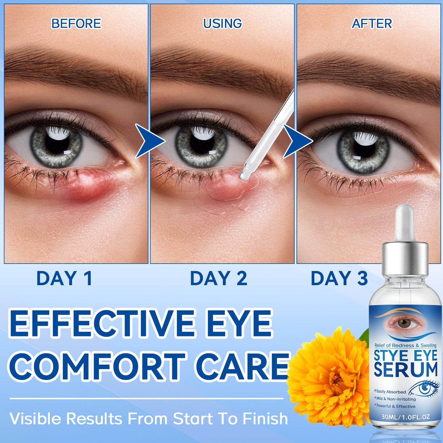 Stye Eye Treatment, 30ml Natural Eye Serum, Eye Stye Relief Serum for Eye Styes, Blepharitis, Chalazions and Dry Eyes Treatment, Daily Area Cleansing, Relieves Dryness and Restores Healthier Skin