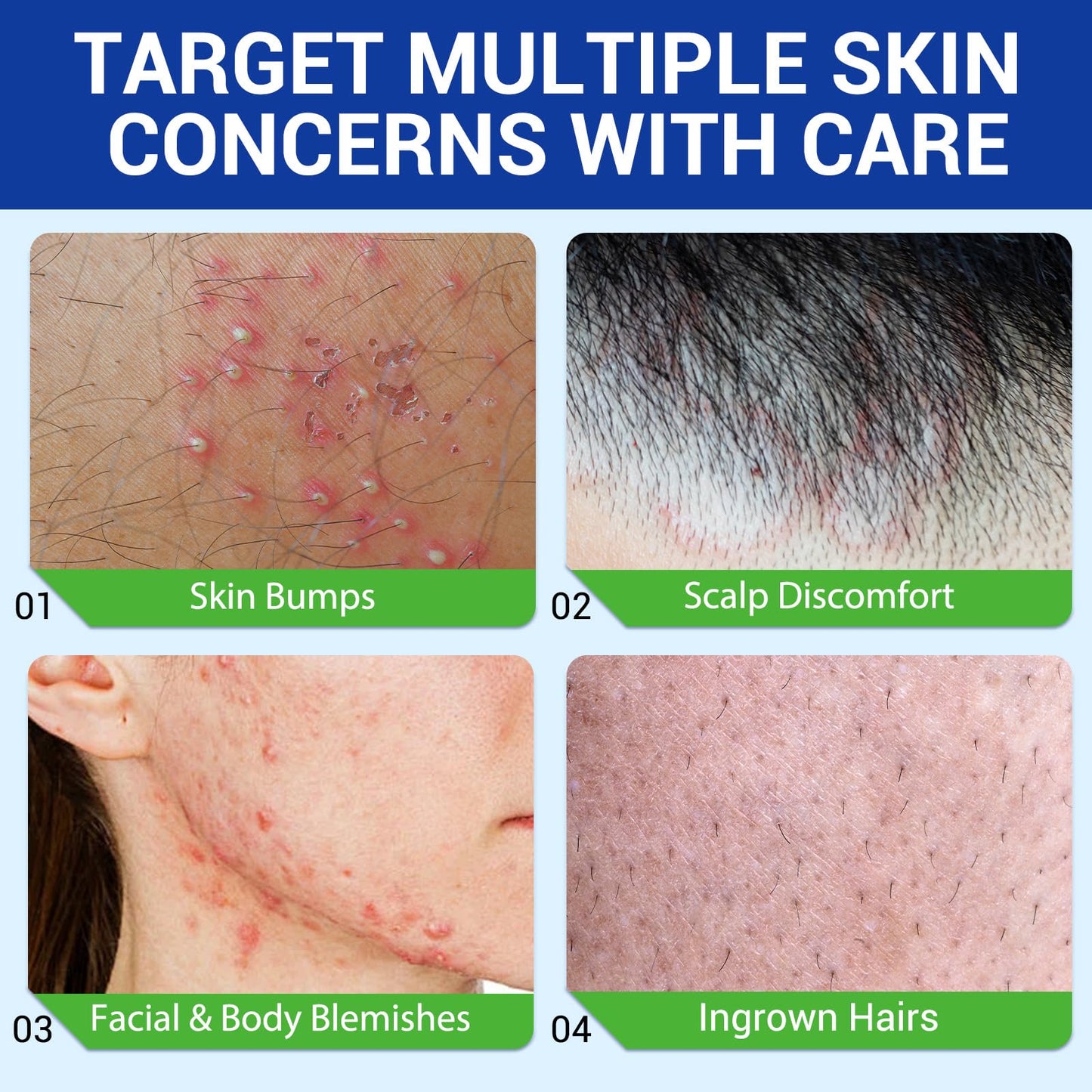 Folliculitis & Acne Treatment Cream Salicylic Acid & Herbal Extracts for Scalp, Face, Body & Back Soothes Redness, Itch & Irritated Skin-120g
