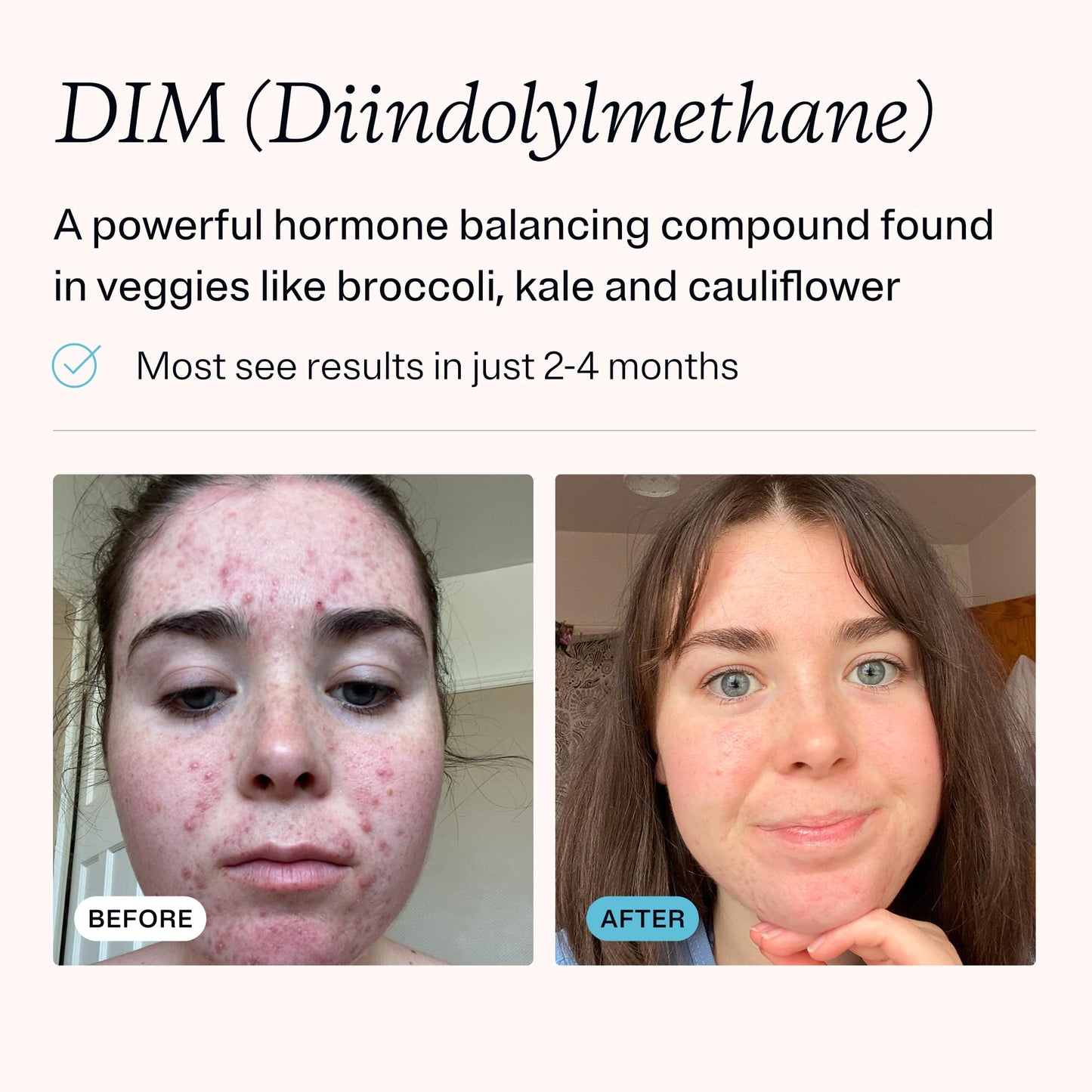 MDacne DIM Skin Clearing Supplements (30 Vegan Capsules) - for Acne Treatment, Estrogen Balance, Hormone Menopause Relief & Bodybuilding, Cruciferous Extract & Bioperine (30 Count (Pack of 1))