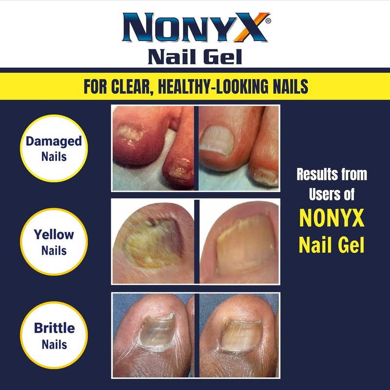 NONYX Fungal Nail Clarifying Gel - Clinically Proven Treatment for Discolored, Thick, and Brittle Toenails | 90% Improvement Rate