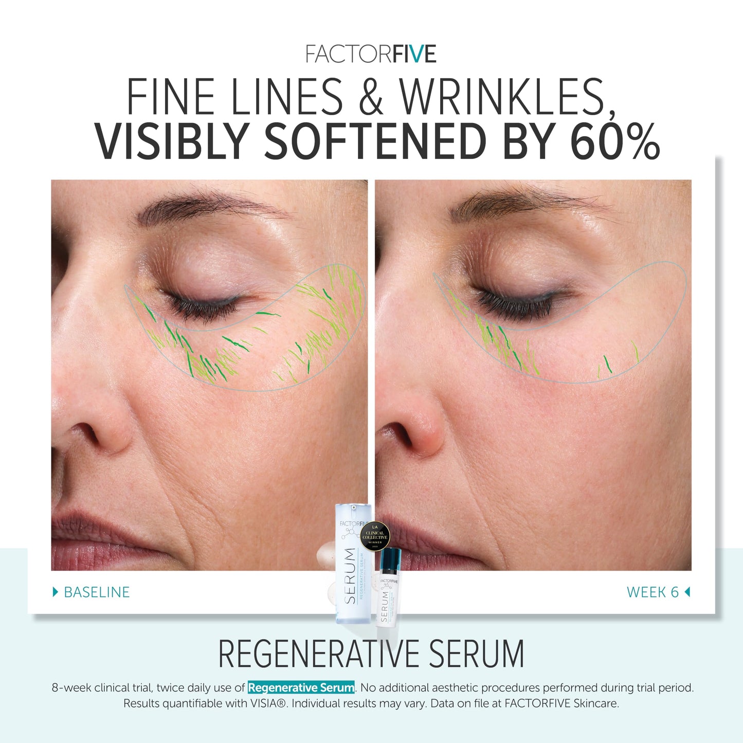 FACTORFIVE Regenerative Serum with Stem Cell Growth Factors, HGF for Skin Tightening and Smoothing, Wrinkle and Pore Reduction, and Rejuvenation - 1 fl oz/30ml