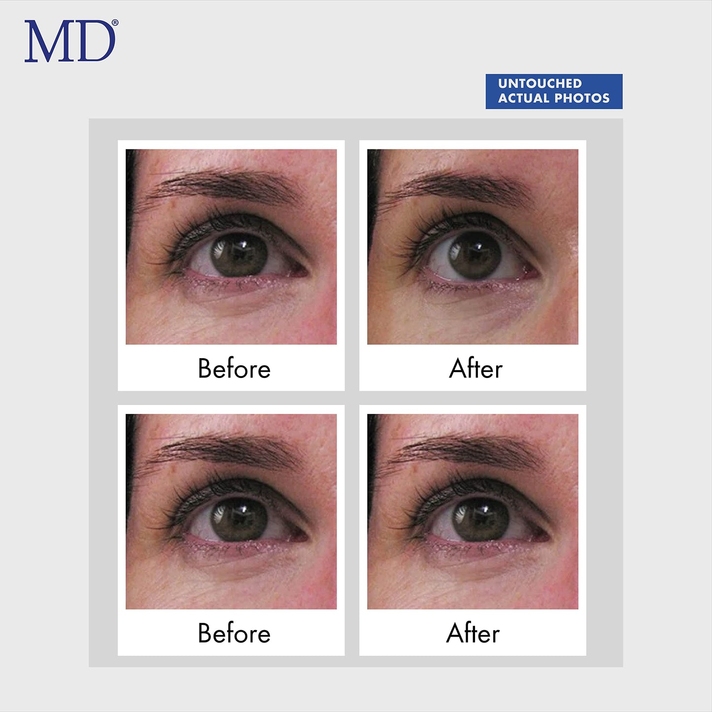 MD Ultimate Eye Cream – Under Eye Cream for Reduced Dark Circles, Puffiness, Wrinkles, Bags & Anti-Aging – Enriched with Collagen, Peptides, Shea Butter for Firmness, Lifting & Moisturization