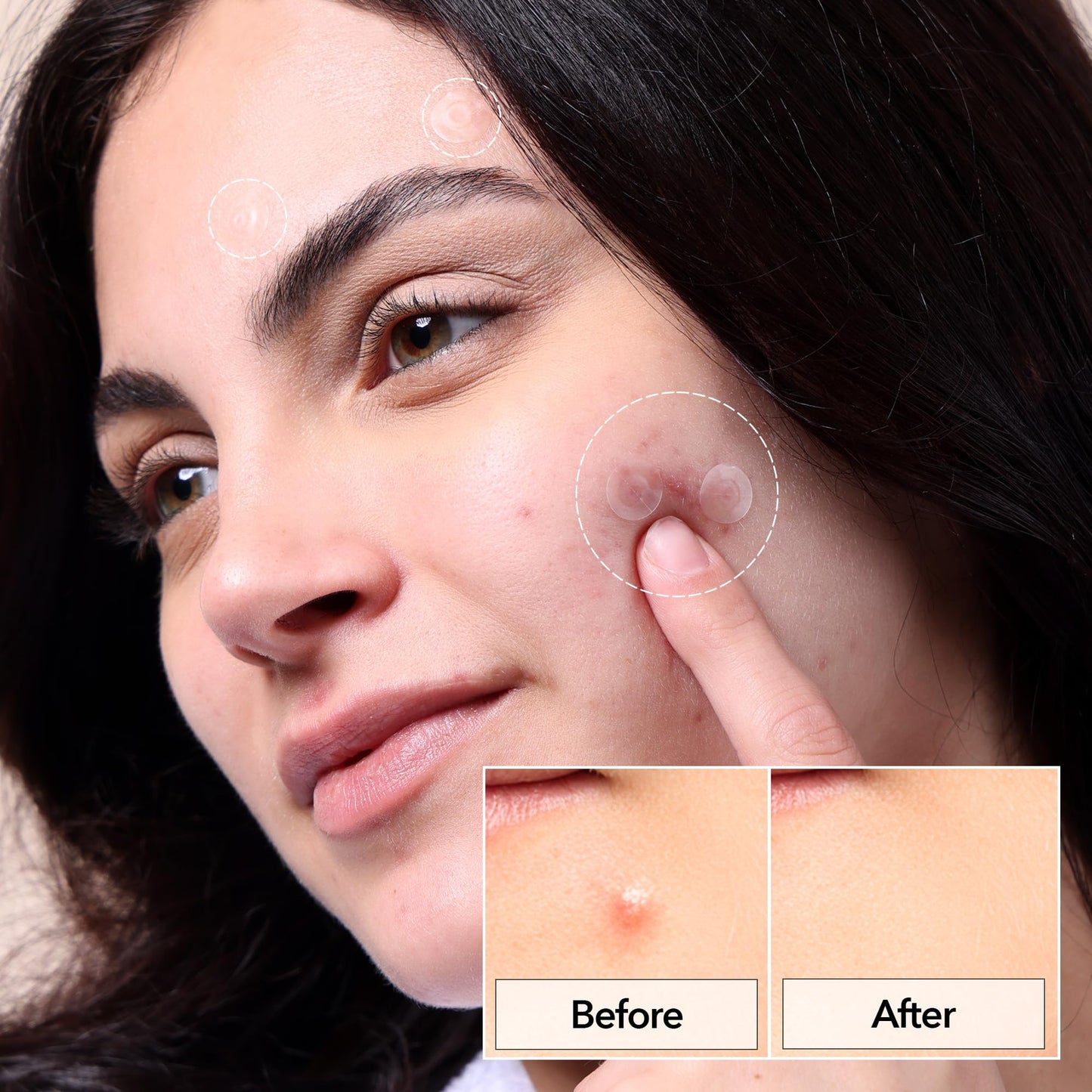 FreeGo Invisible+ Hydrocolloid Spot Pimple Patches for Face, Large Patches for Breakouts, Zit, Blemish Spot, Facial Stickers, Korean Pimple Patches (132 Counts)