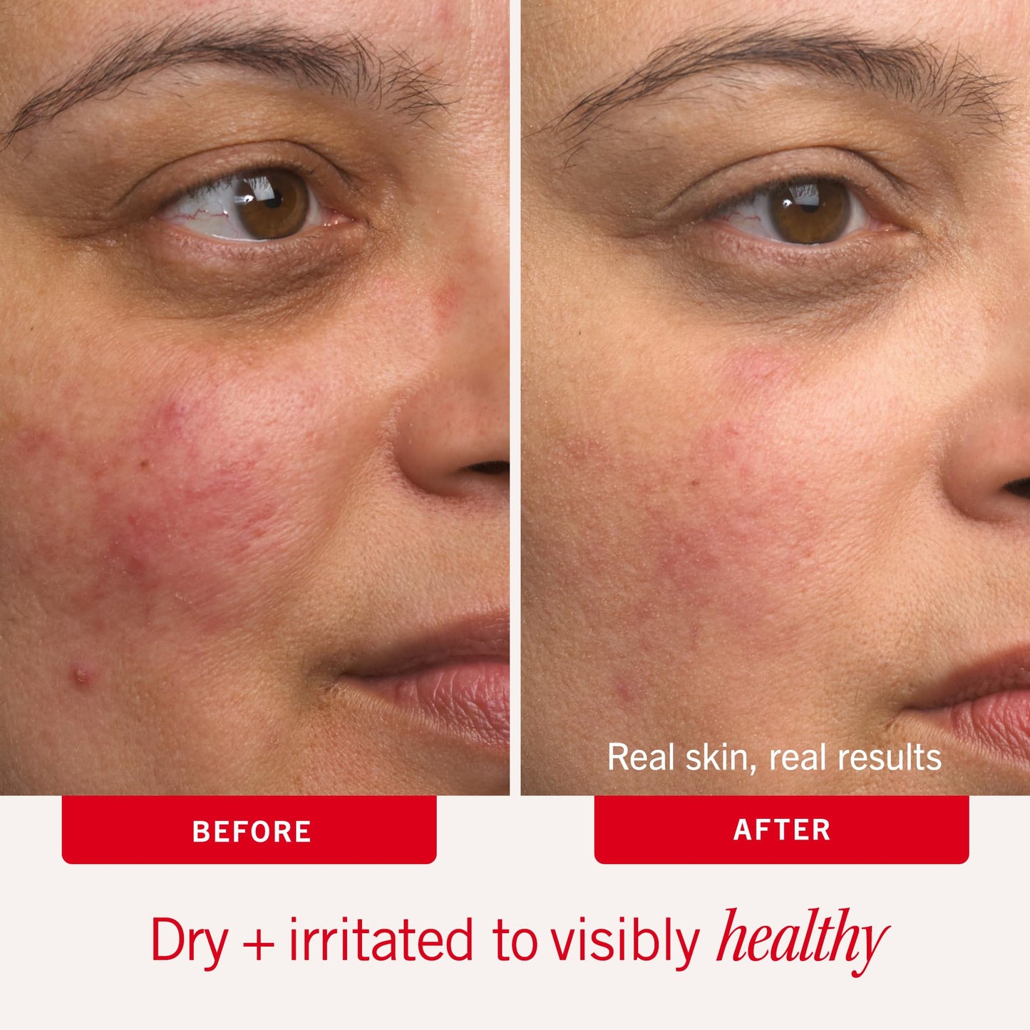 First Aid Beauty Ultra Repair Cream, Intense Hydration - Clinically Tested Face & Body Moisturizer with Colloidal Oatmeal - Supports Eczema & Dry Skin Barrier Repair - Fragrance Free - 7 oz Total