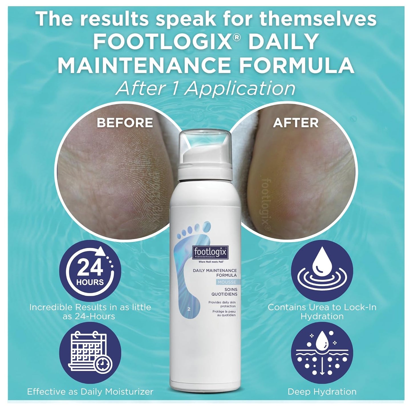 FOOTLOGIX Daily Maintenance Formula - Foot Moisturizer, Foot Mousse for Normal to Dry Skin Maintenance, Foot Mousse for Calluses and Dry Feet, 4.23oz