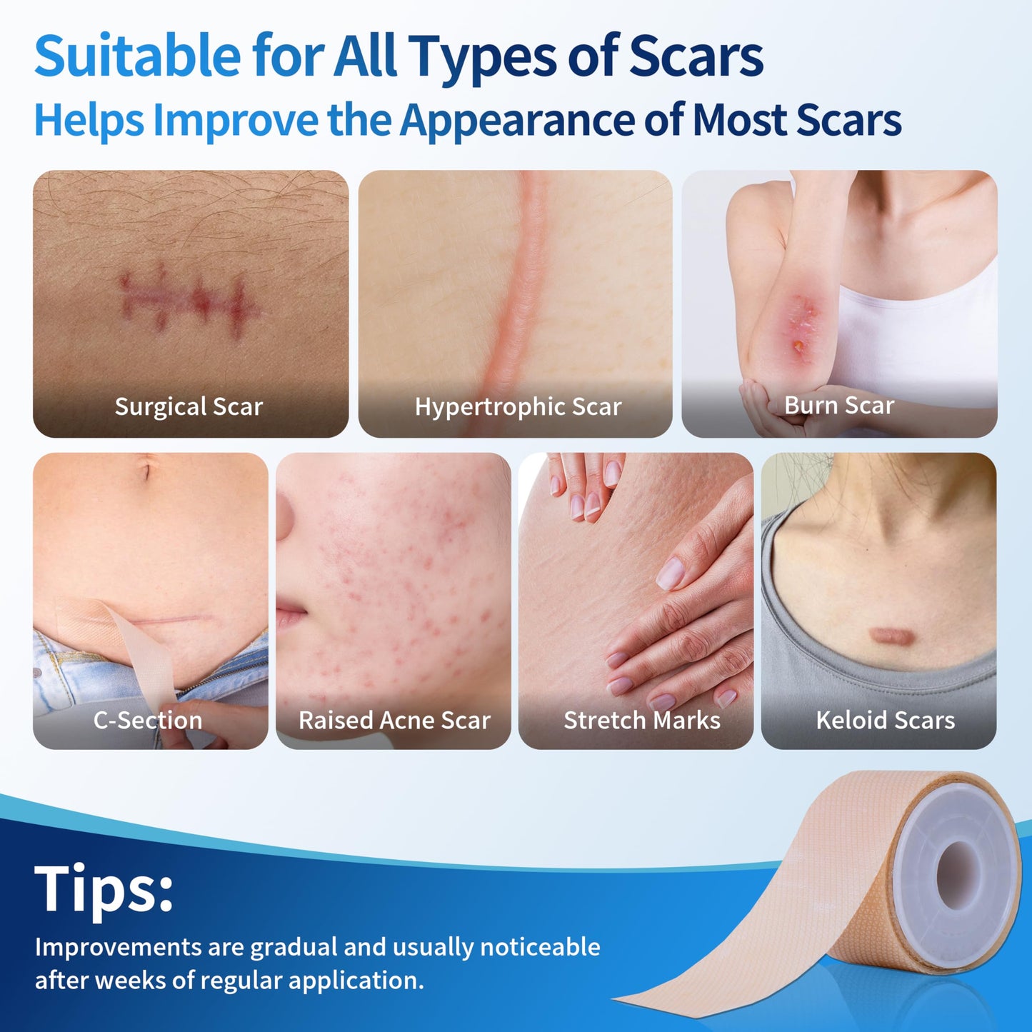 HBM Medical Grade Silicone Scar Tape, Scar Silicone Strips,Silicone Scar Sheets for Surgical Scars, C-Section, Keloid, Burn, Acne, Reusable Scar Removal Tape for Old & New Scars (4 x 150 cm)