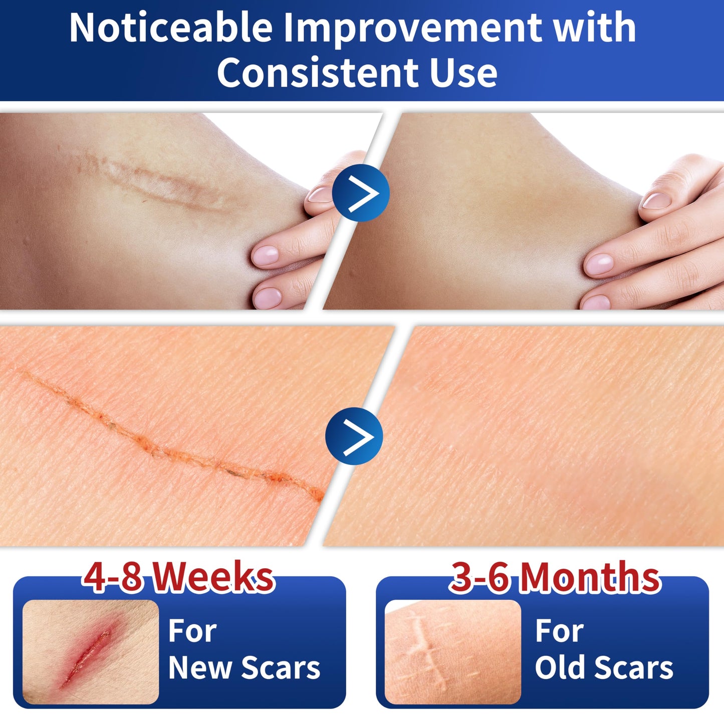 HBM Medical Grade Silicone Scar Tape, Scar Silicone Strips,Silicone Scar Sheets for Surgical Scars, C-Section, Keloid, Burn, Acne, Reusable Scar Removal Tape for Old & New Scars (4 x 150 cm)