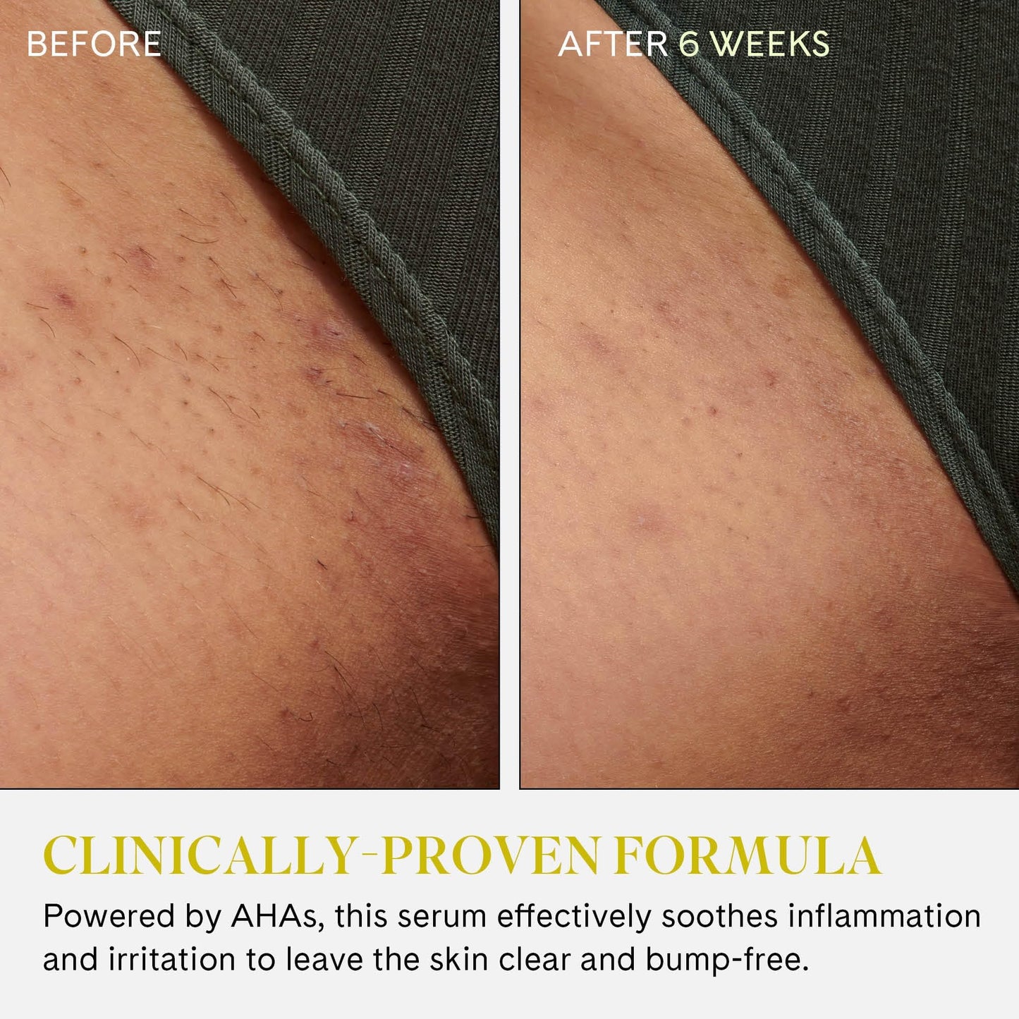 Fur Ingrown Eliminator Serum Rollerball Travel Size - Ingrown Hair Treatment Serum With AHAs and BHAs to Treat Ingrown Hairs and Bumps, Hydrates and Soothes Irritated Skin - 10 ml (Magnet Included)