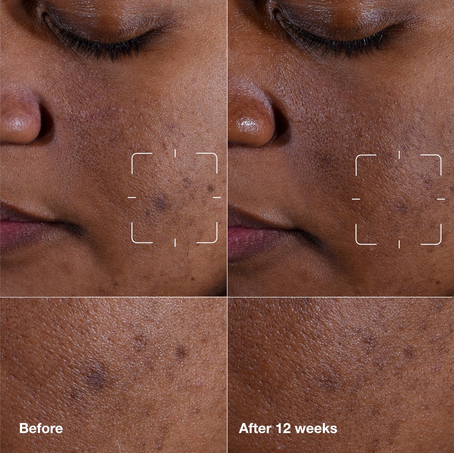 Clinique Even Better Clinical Dark Spot Clearing Vitamin C Face Serum For All Skin Types | Brightening + Soothing, 1.7 Fl Oz