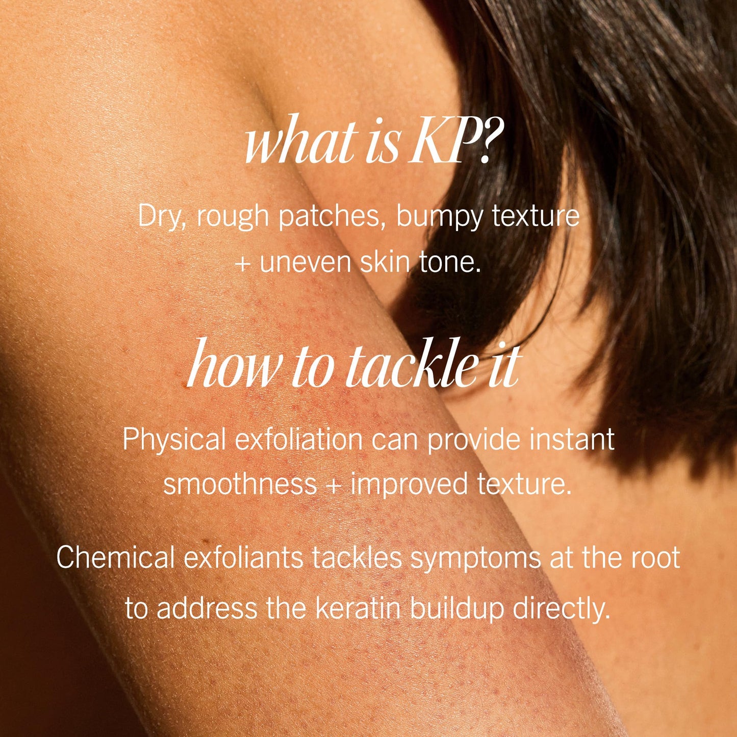 First Aid Beauty - KP Bump Eraser Body Scrub with 10% AHA, Keratosis Pilaris Skin Exfoliater with Glycolic and Lactic acids, Helps Reduce Chicken Skin Bumps, Safe for Sensitive Skin, 8 oz + Bonus, 2ct